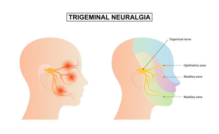 Neuralgia do trigêmeo 