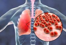 pneumonia