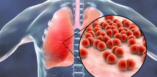 pneumonia